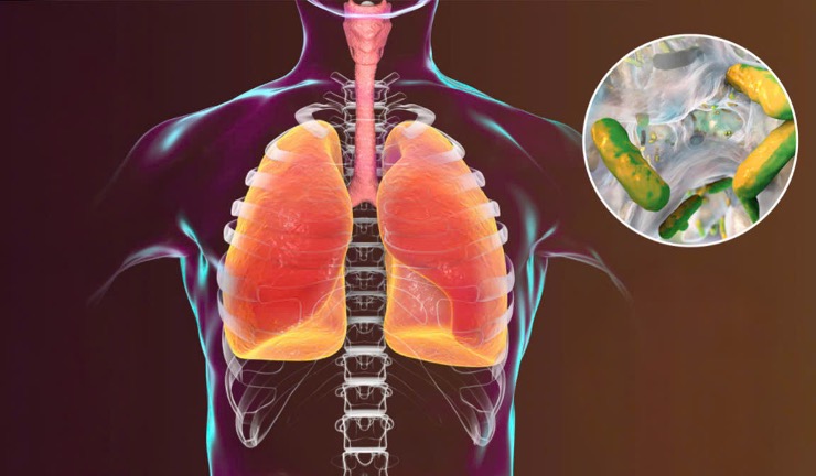 NGUY CƠ NHIỄM KHUẨN PSEUDOMONAS AERUGINOSA