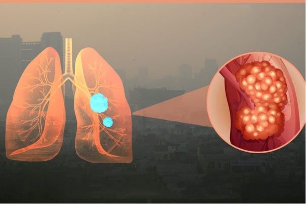 MỐI LIÊN HỆ GIỮA Ô NHIỄM KHÔNG KHÍ VÀ BỆNH ĐƯỜNG HÔ HẤP Ở TRẺ EM